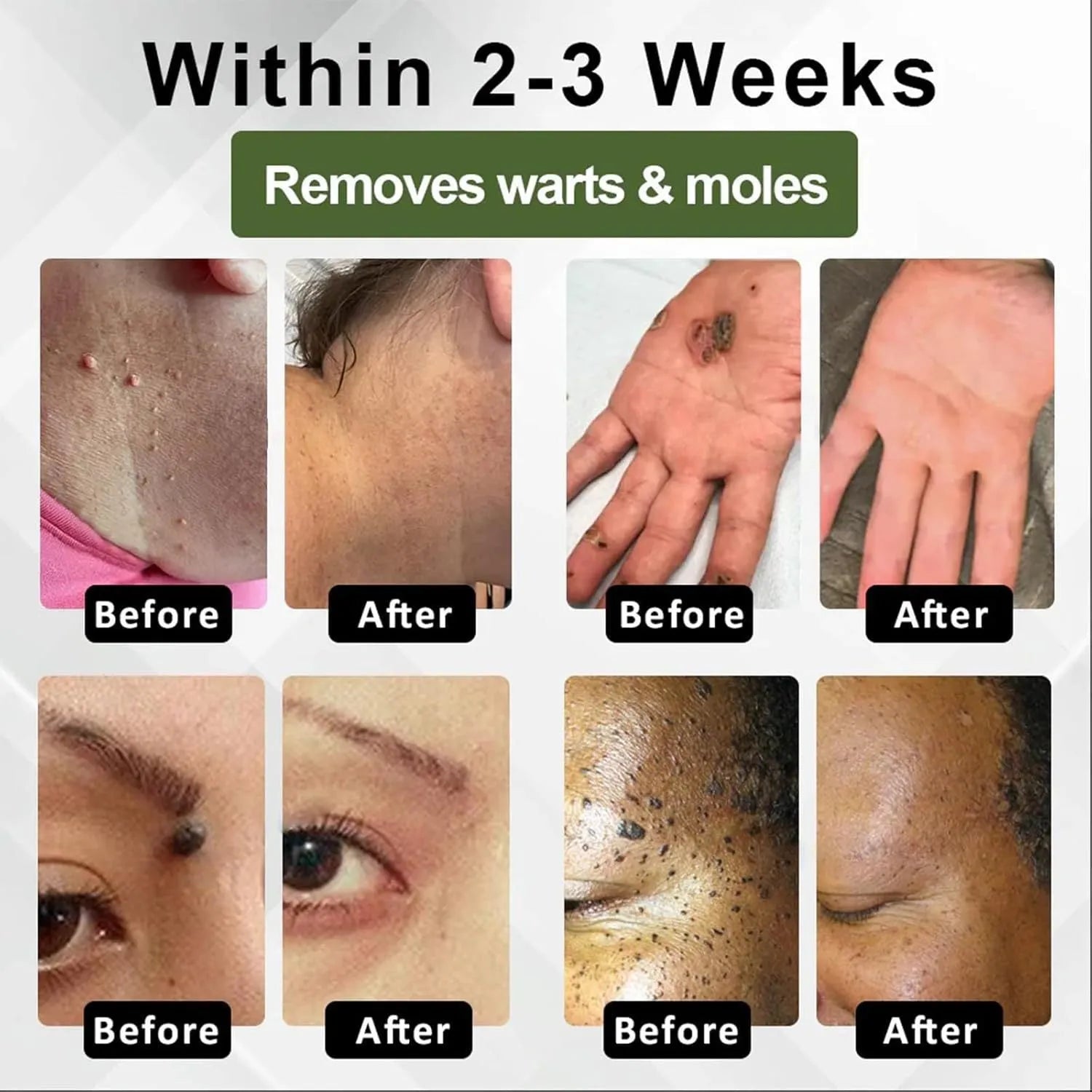 Natureerase Instant Mole Spot Removal Gel 45g tube for hydrating body care on universal skin types