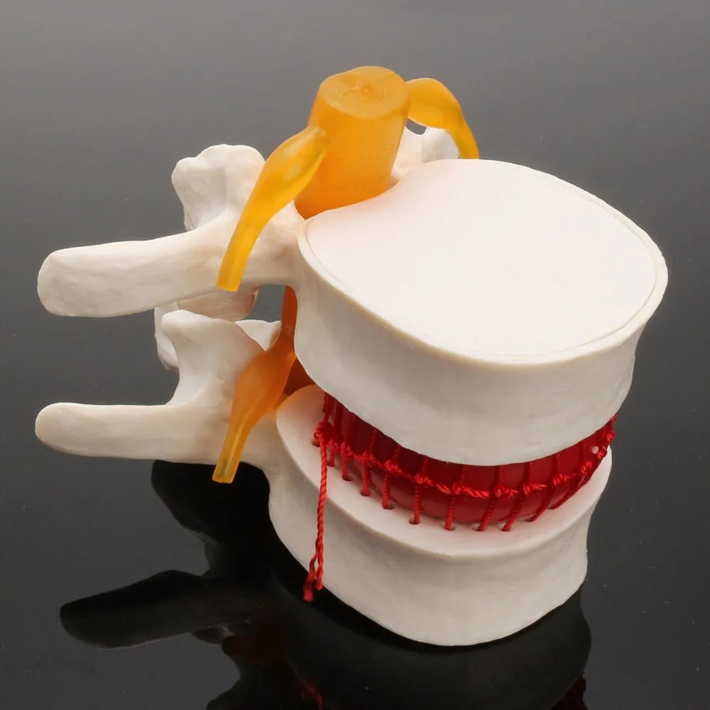 White PVC medical model showing lumbar intervertebral disc herniation anatomy for demonstration purposes