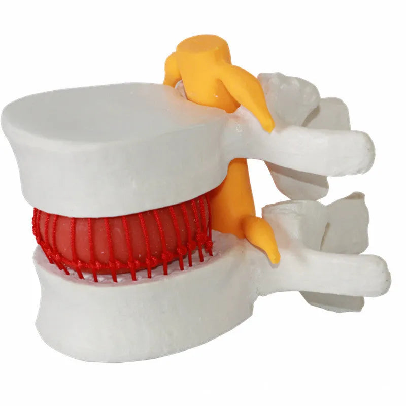 White PVC medical model showing lumbar intervertebral disc herniation anatomy for demonstration purposes