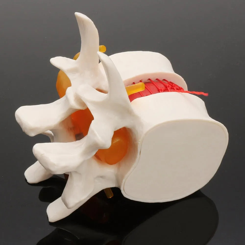 White PVC medical model showing lumbar intervertebral disc herniation anatomy for demonstration purposes