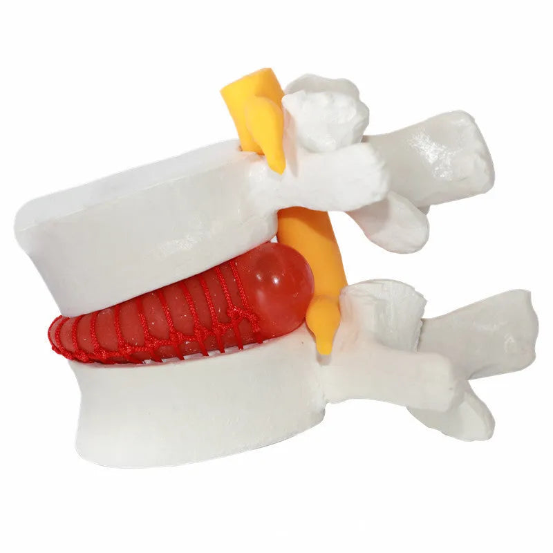 White PVC medical model showing lumbar intervertebral disc herniation anatomy for demonstration purposes