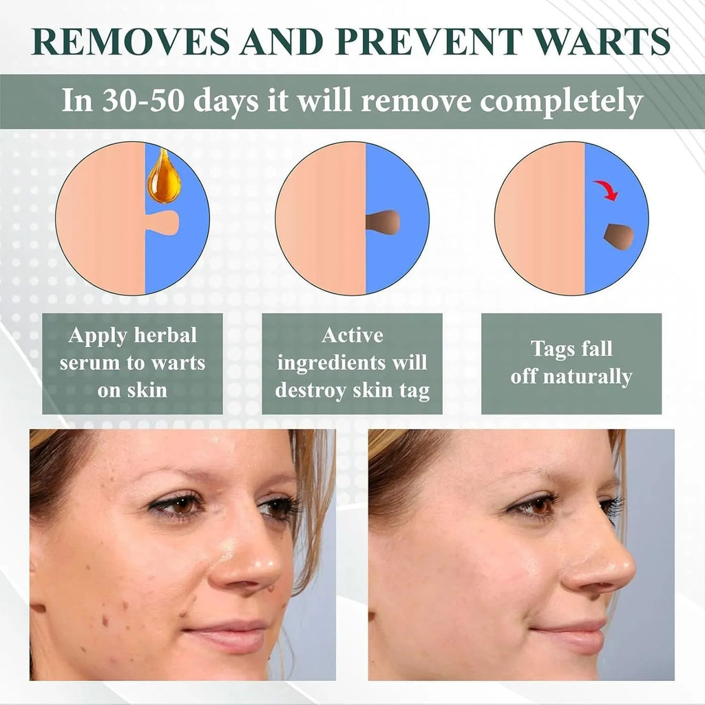 Natureerase Instant Mole Spot Removal Gel 45g tube for hydrating body care on universal skin types