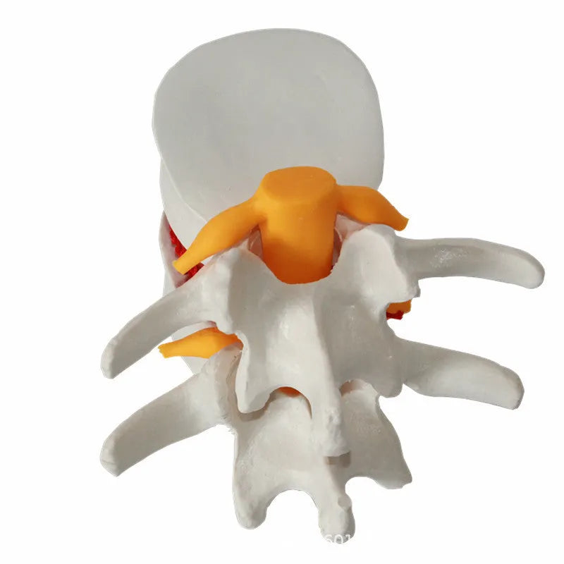 White PVC medical model showing lumbar intervertebral disc herniation anatomy for demonstration purposes