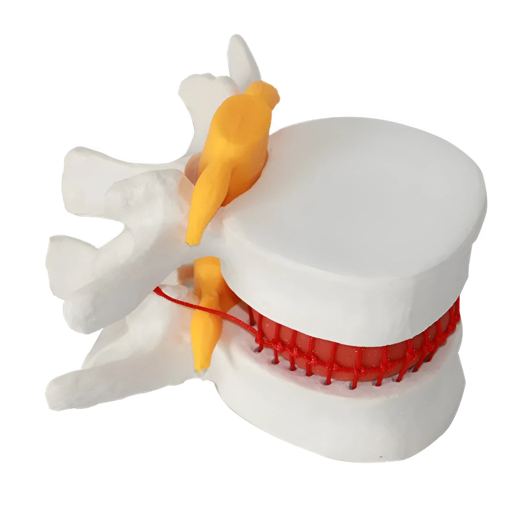 White PVC medical model showing lumbar intervertebral disc herniation anatomy for demonstration purposes