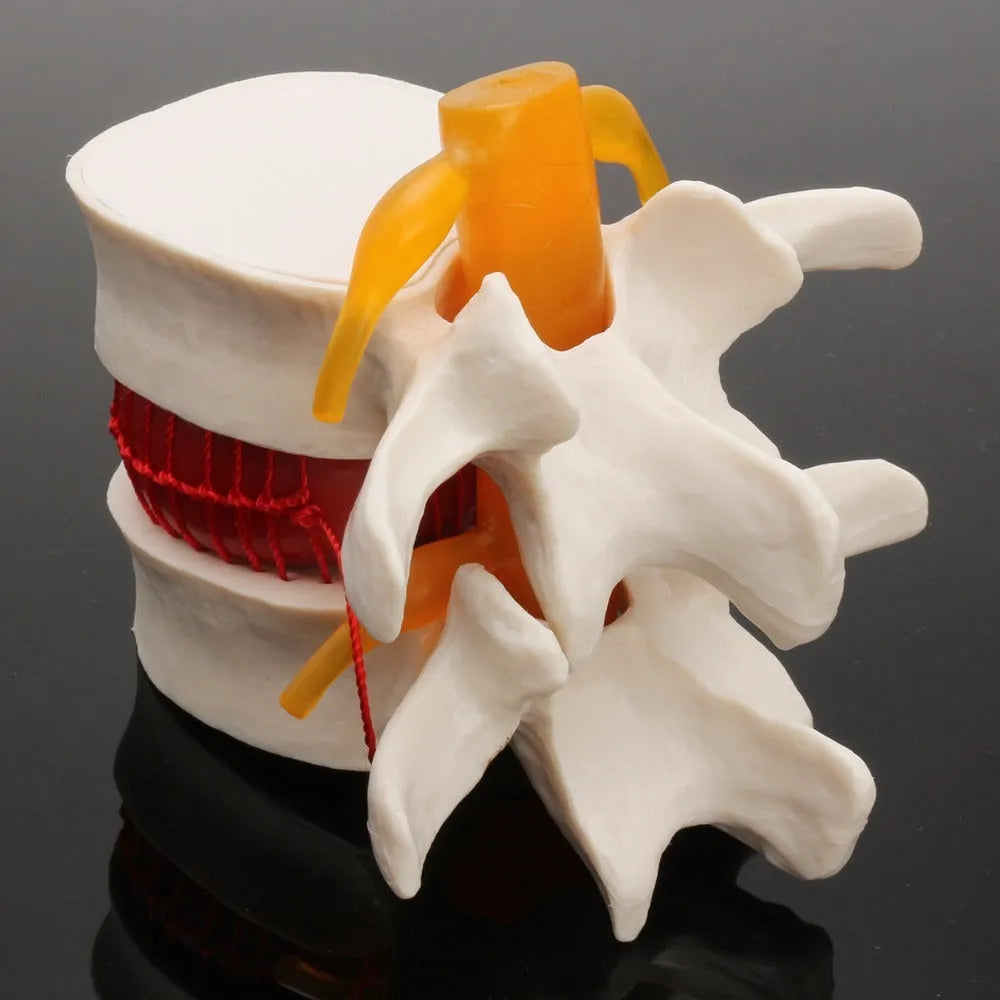 White PVC medical model showing lumbar intervertebral disc herniation anatomy for demonstration purposes