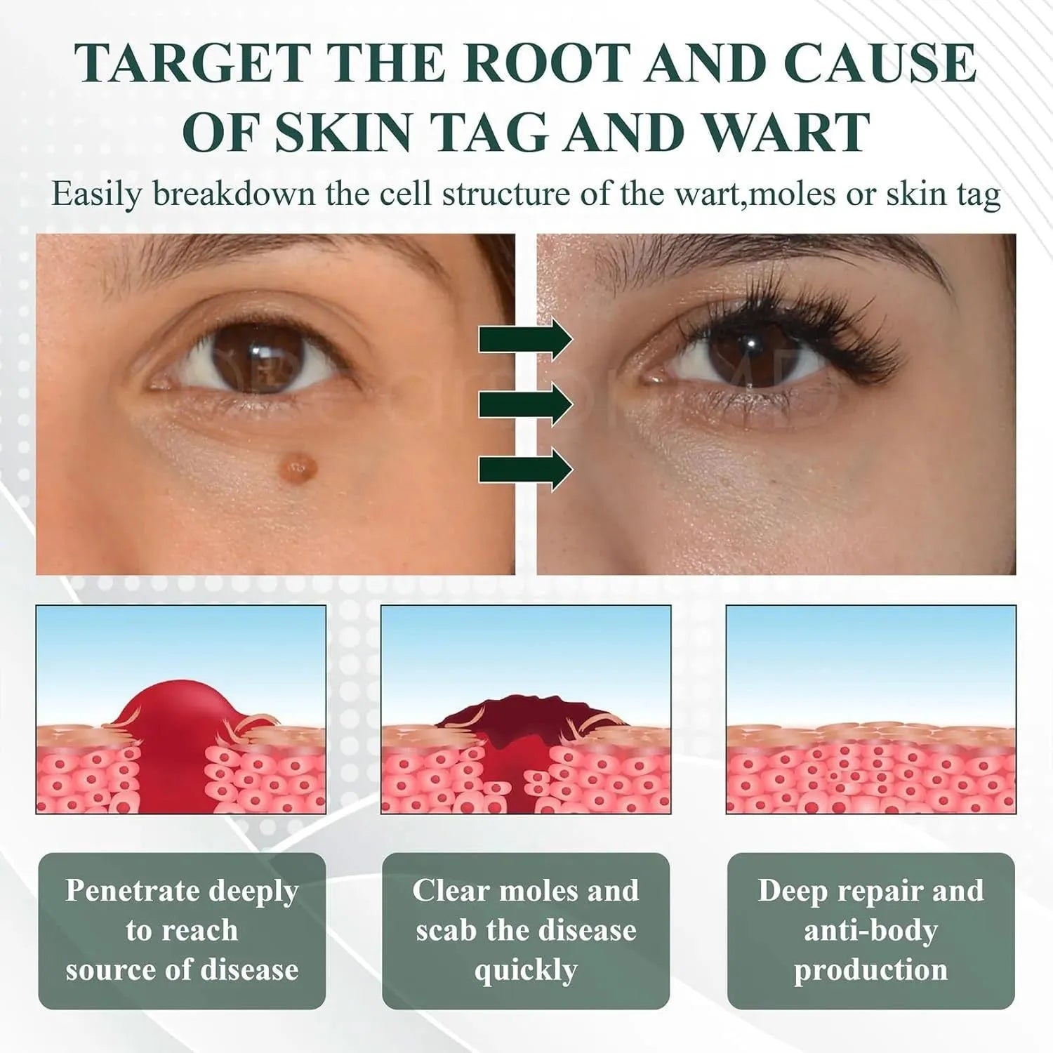Natureerase Instant Mole Spot Removal Gel 45g tube for hydrating body care on universal skin types