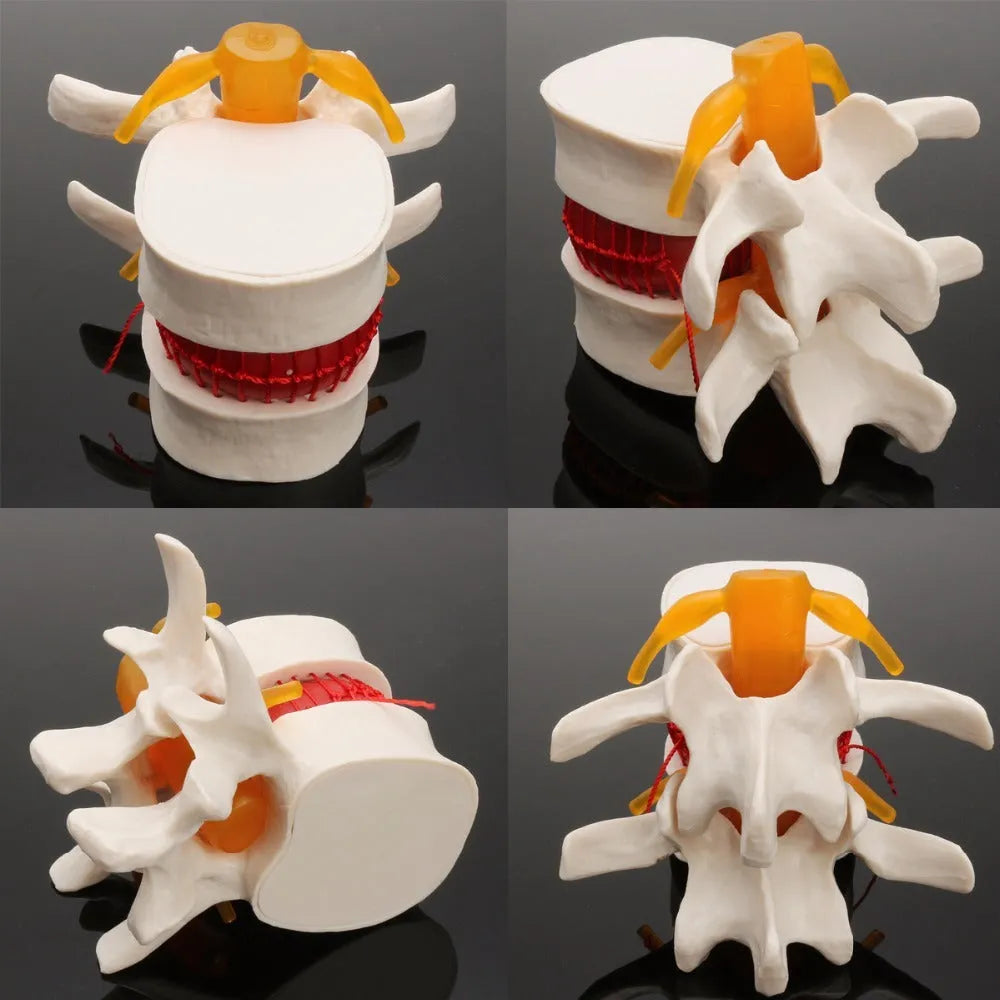 White PVC medical model showing lumbar intervertebral disc herniation anatomy for demonstration purposes